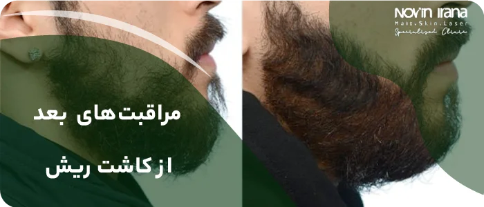مراقبتهای بعد از کاشت ریش